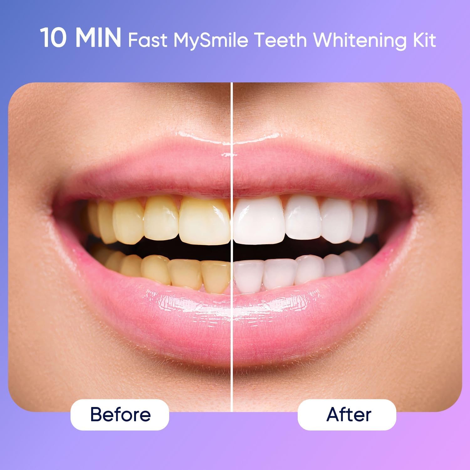 MySmile Deluxe 10 Min Teeth Whitening Kit with 28 LED Light, 35% Carbamide Peroxide Teeth Whitening Gel, Helps Remove Years of Stains from Coffee, Soda, Wines, Smoking, Food